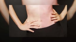 التشيميرية هي حالة يولد فيها الفرد بمجموعتين من الحمض النووي لأنه امتص توأمه أثناء وجوده في الرحم.