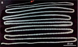 Médicos descobrem verme-cesto de 6 metros no intestino delgado de homem por mais de dois anos, devido ao consumo constante de carne crua