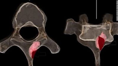 Scientists Found Cancer Cells in a 1.7 Million-Year-Old Foot Bone and a 2 Million-Year-Old Spine from Two Ancient Hominin Specimens in South Africa.