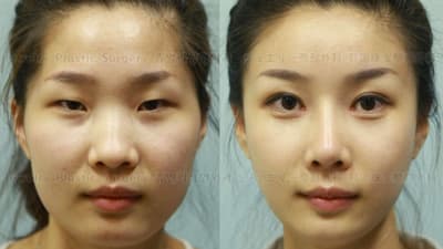 许多前往韩国进行低价且高质量整形手术的中国医疗游客，因为护照照片与手术后新面容不符，而难以重新入境中国。