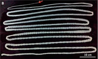 Врачи обнаружили 6‑метрового ленточного червя, жившего в тонкой кишке мужчины более двух лет из‑за постоянного употребления сырой говядины.