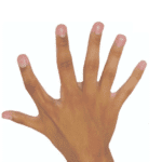 Polydactyly