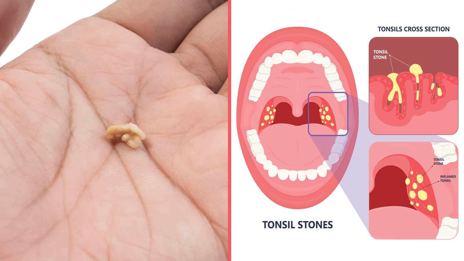 What Are Tonsil Stones?